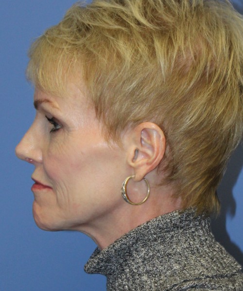 Rhinoplasty 5078 – Click HERE for more views after photo. Individual results may vary.