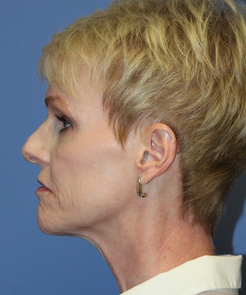 Rhinoplasty 5078 – Click HERE for more views before photo. Individual results may vary.