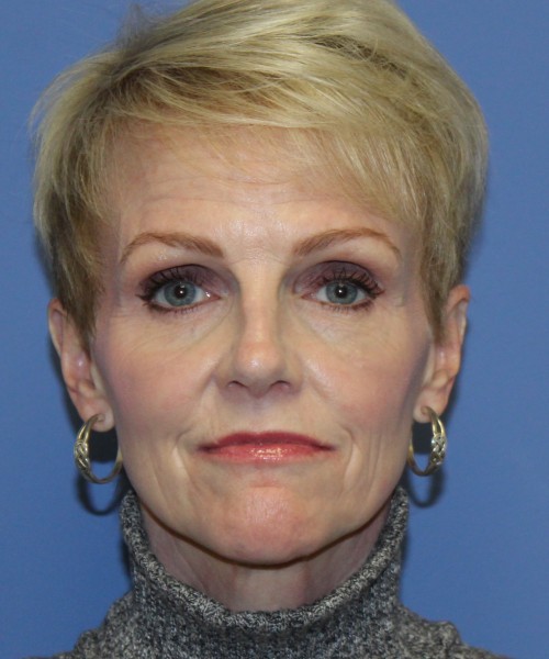 Rhinoplasty 5078 – Click HERE for more views after photo. Individual results may vary.