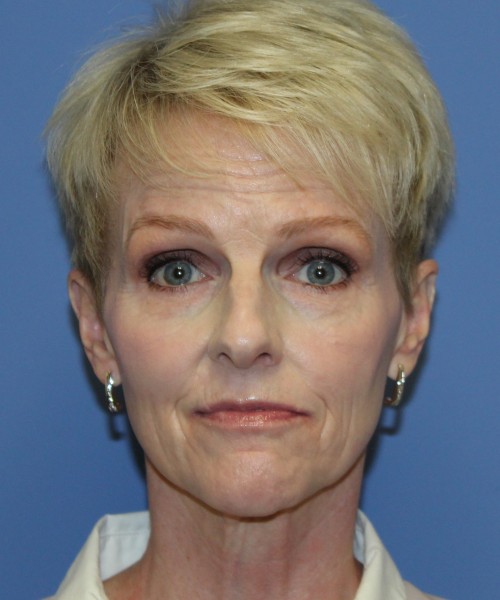 Rhinoplasty 5078 – Click HERE for more views before photo. Individual results may vary.