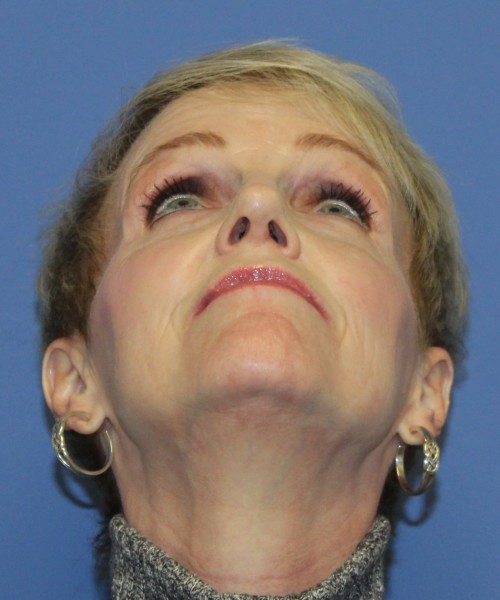 Rhinoplasty 5078 – Click HERE for more views after photo. Individual results may vary.