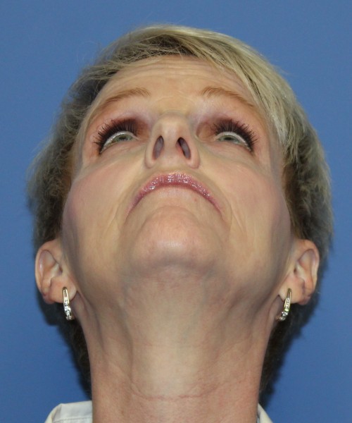 Rhinoplasty 5078 – Click HERE for more views before photo. Individual results may vary.