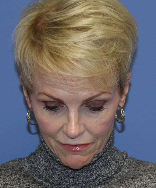 Rhinoplasty 5078 – Click HERE for more views after photo. Individual results may vary.