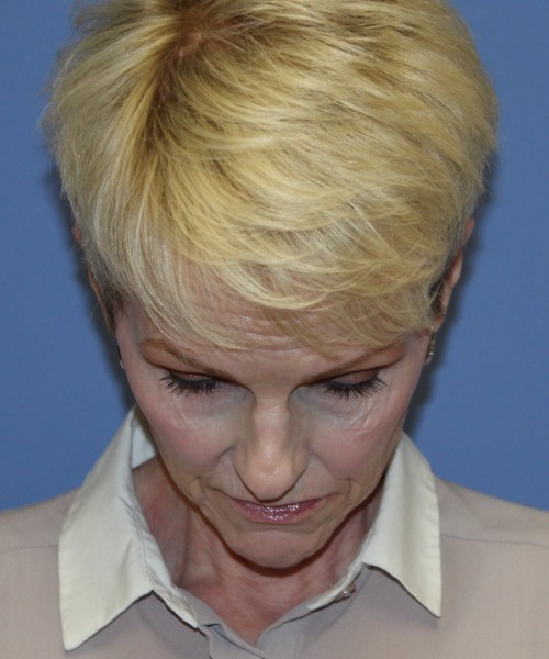 Rhinoplasty 5078 – Click HERE for more views before photo. Individual results may vary.