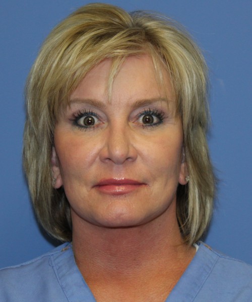 Facelift, Browlift, Lip Augmentation 5093 – Click HERE for more views after photo. Individual results may vary.