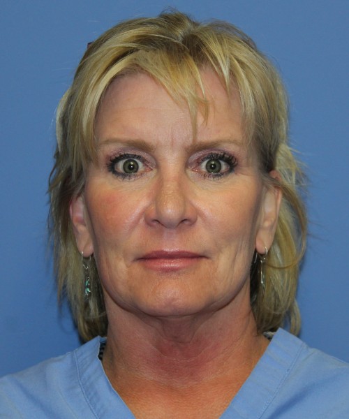 Facelift, Browlift, Lip Augmentation 5093 – Click HERE for more views before photo. Individual results may vary.