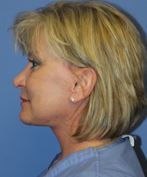 Facelift, Browlift, Lip Augmentation 5093 – Click HERE for more views after photo. Individual results may vary.