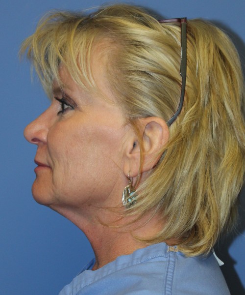 Facelift, Browlift, Lip Augmentation 5093 – Click HERE for more views before photo. Individual results may vary.