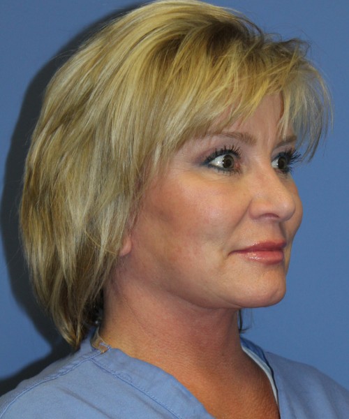 Facelift, Browlift, Lip Augmentation 5093 – Click HERE for more views after photo. Individual results may vary.
