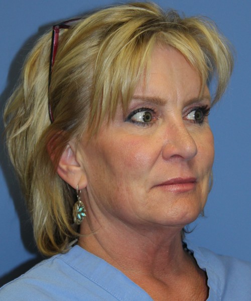Facelift, Browlift, Lip Augmentation 5093 – Click HERE for more views before photo. Individual results may vary.