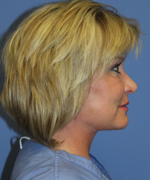 Facelift, Browlift, Lip Augmentation 5093 – Click HERE for more views after photo. Individual results may vary.