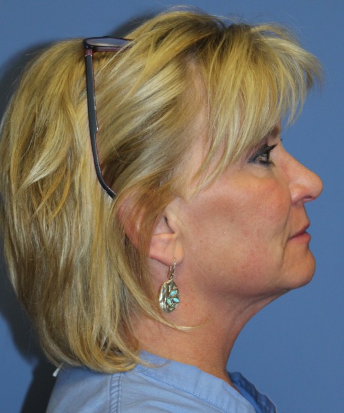 Facelift, Browlift, Lip Augmentation 5093 – Click HERE for more views before photo. Individual results may vary.