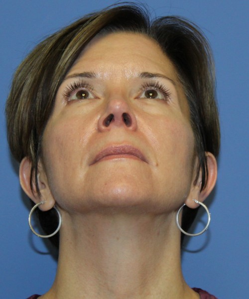 Rhinoplasty 5104 – Click HERE for more views after photo. Individual results may vary.