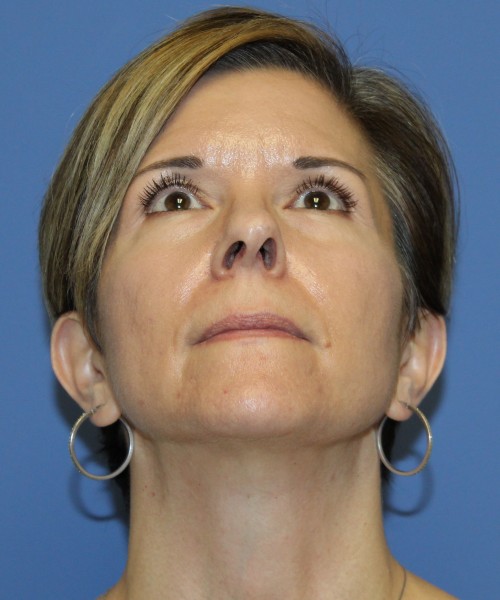 Rhinoplasty 5104 – Click HERE for more views before photo. Individual results may vary.