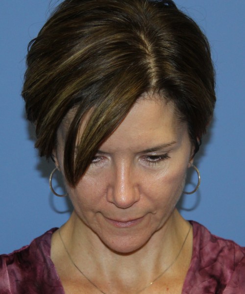 Rhinoplasty 5104 – Click HERE for more views after photo. Individual results may vary.