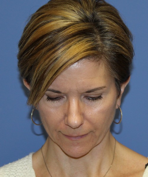 Rhinoplasty 5104 – Click HERE for more views before photo. Individual results may vary.