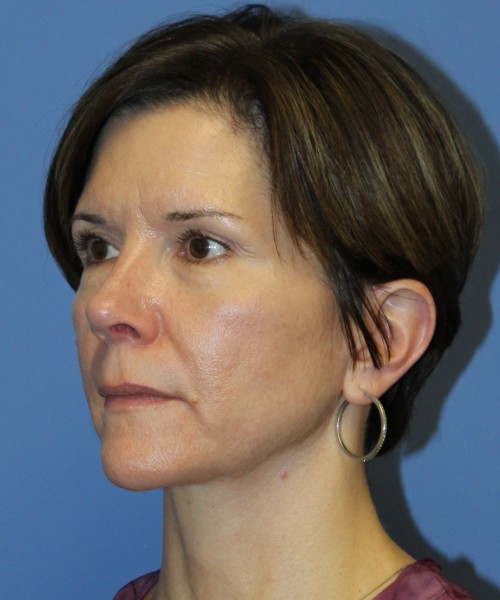 Rhinoplasty 5104 – Click HERE for more views after photo. Individual results may vary.