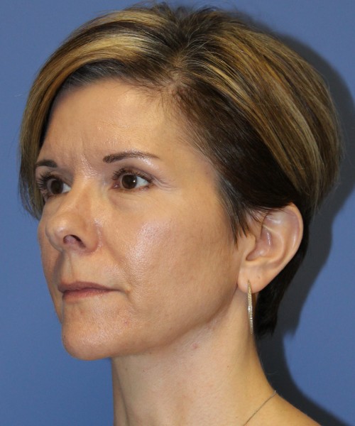 Rhinoplasty 5104 – Click HERE for more views before photo. Individual results may vary.