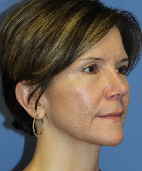 Rhinoplasty 5104 – Click HERE for more views after photo. Individual results may vary.