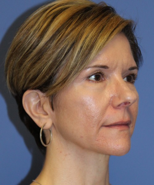 Rhinoplasty 5104 – Click HERE for more views before photo. Individual results may vary.