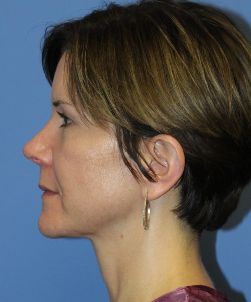Rhinoplasty 5104 – Click HERE for more views after photo. Individual results may vary.