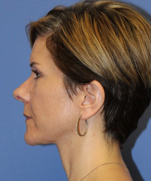 Rhinoplasty 5104 – Click HERE for more views before photo. Individual results may vary.