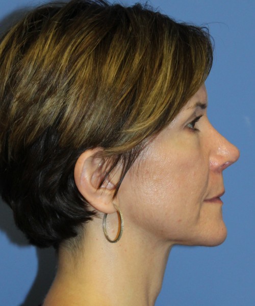 Rhinoplasty 5104 – Click HERE for more views after photo. Individual results may vary.