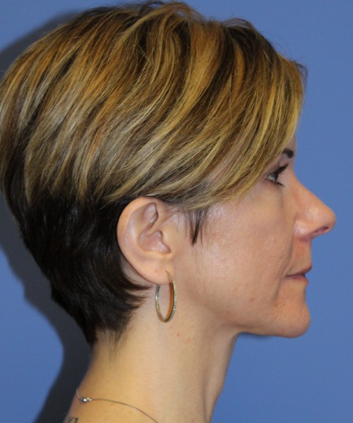 Rhinoplasty 5104 – Click HERE for more views before photo. Individual results may vary.