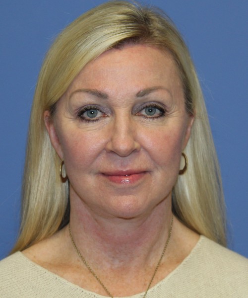 Facelift, Browlift, Hairline Advancement, Lip Augmentation 5157 – Click HERE for more views after photo. Individual results may vary.