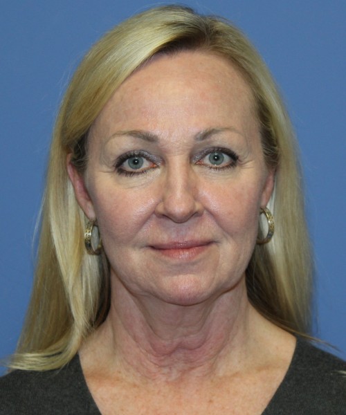 Facelift, Browlift, Hairline Advancement, Lip Augmentation 5157 – Click HERE for more views before photo. Individual results may vary.
