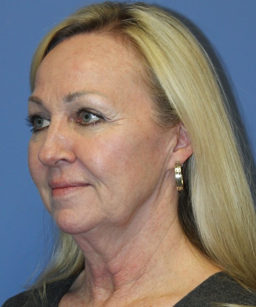 Facelift, Browlift, Hairline Advancement, Lip Augmentation 5157 – Click HERE for more views before photo. Individual results may vary.