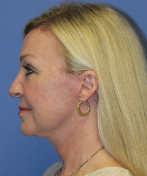 Facelift, Browlift, Hairline Advancement, Lip Augmentation 5157 – Click HERE for more views after photo. Individual results may vary.