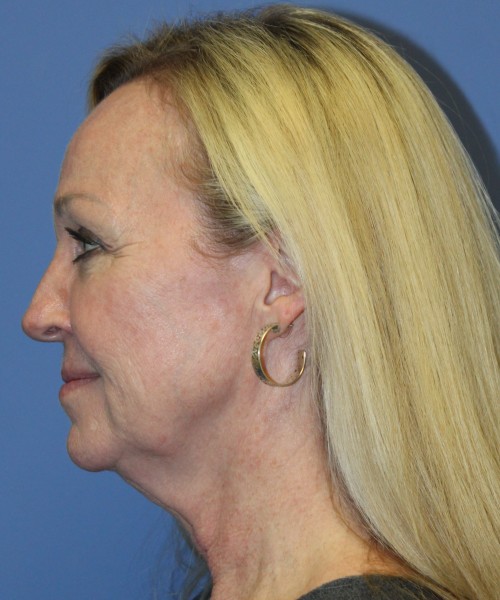 Facelift, Browlift, Hairline Advancement, Lip Augmentation 5157 – Click HERE for more views before photo. Individual results may vary.