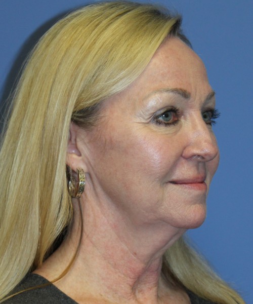 Facelift, Browlift, Hairline Advancement, Lip Augmentation 5157 – Click HERE for more views before photo. Individual results may vary.