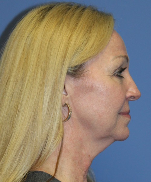 Facelift, Browlift, Hairline Advancement, Lip Augmentation 5157 – Click HERE for more views before photo. Individual results may vary.