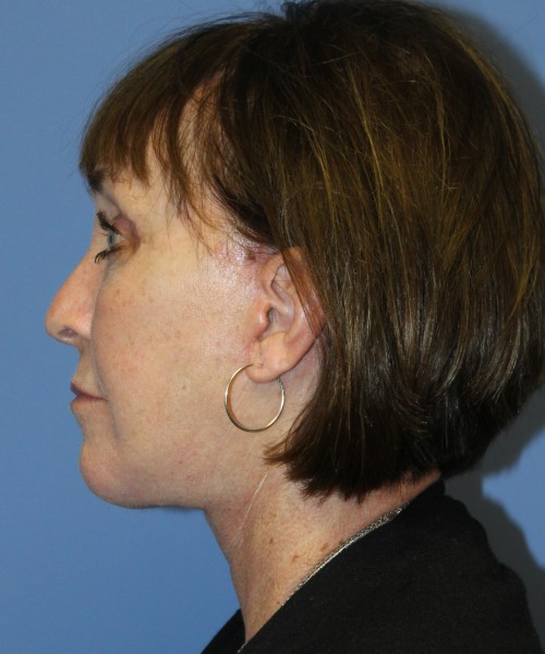 Facelift, Browlift, Lip Augmentation, Facial Fat Grafting, Blepharoplasty (Eyelids), Laser Skin Resurfacing #5180 – Click HERE for more views after photo. Individual results may vary.