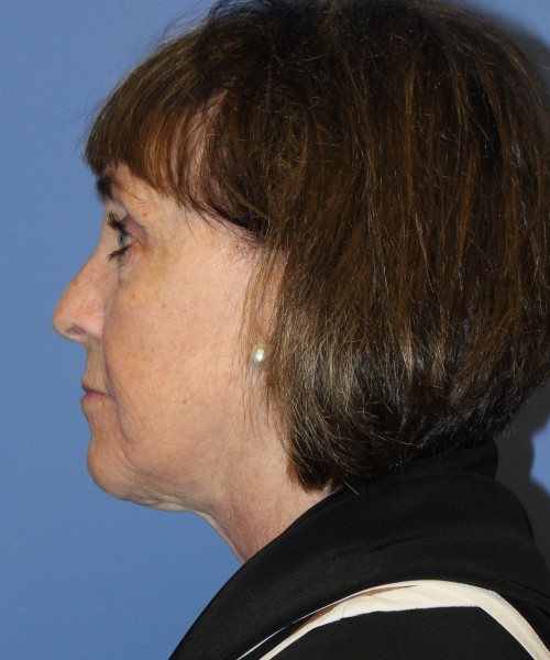 Facelift, Browlift, Lip Augmentation, Facial Fat Grafting, Blepharoplasty (Eyelids), Laser Skin Resurfacing #5180 – Click HERE for more views before photo. Individual results may vary.