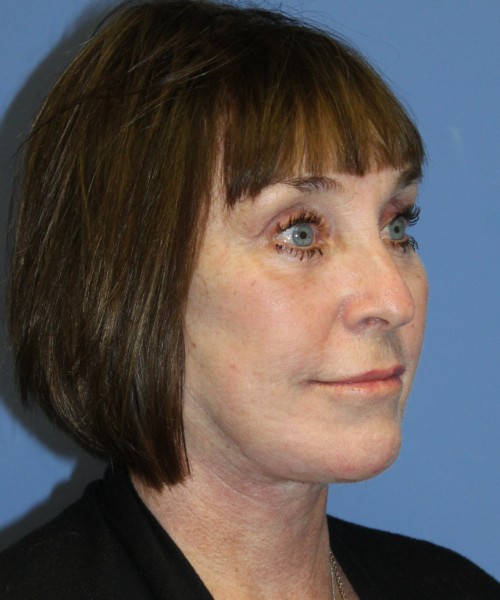 Facelift, Browlift, Lip Augmentation, Facial Fat Grafting, Blepharoplasty (Eyelids), Laser Skin Resurfacing #5180 – Click HERE for more views after photo. Individual results may vary.