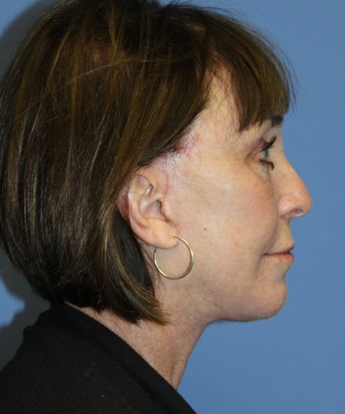 Facelift, Browlift, Lip Augmentation, Facial Fat Grafting, Blepharoplasty (Eyelids), Laser Skin Resurfacing #5180 – Click HERE for more views after photo. Individual results may vary.
