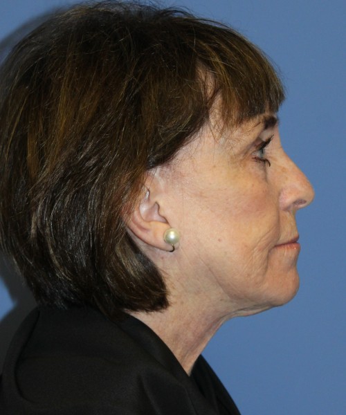 Facelift, Browlift, Lip Augmentation, Facial Fat Grafting, Blepharoplasty (Eyelids), Laser Skin Resurfacing #5180 – Click HERE for more views before photo. Individual results may vary.