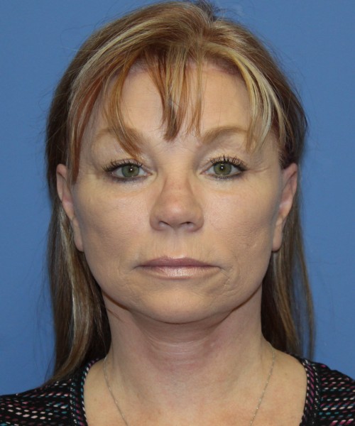 Facelift, Browlift, Blepharoplasty, and SMAS lip augmentation #5192 – Click HERE for more views after photo. Individual results may vary.