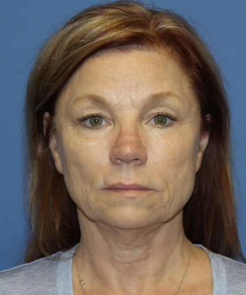 Facelift, Browlift, Blepharoplasty, and SMAS lip augmentation #5192 – Click HERE for more views before photo. Individual results may vary.