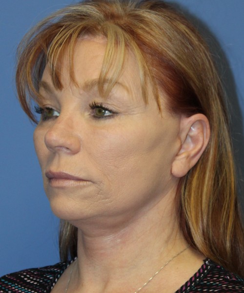Facelift, Browlift, Blepharoplasty, and SMAS lip augmentation #5192 – Click HERE for more views after photo. Individual results may vary.