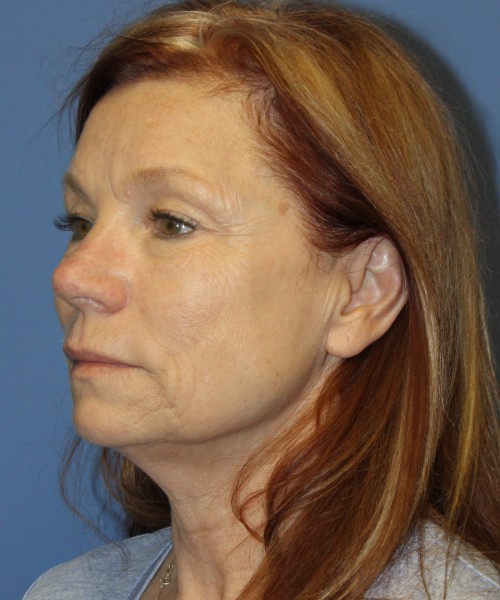 Facelift, Browlift, Blepharoplasty, and SMAS lip augmentation #5192 – Click HERE for more views before photo. Individual results may vary.