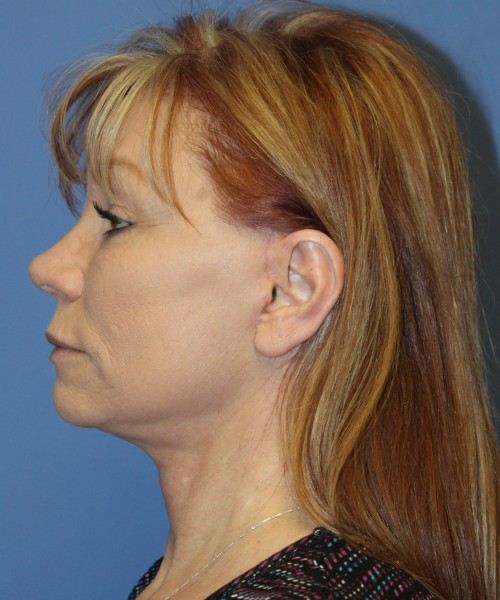 Facelift, Browlift, Blepharoplasty, and SMAS lip augmentation #5192 – Click HERE for more views after photo. Individual results may vary.