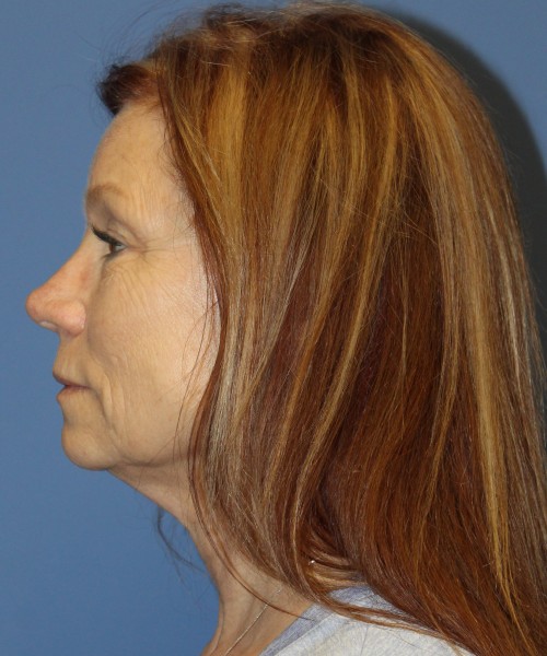 Facelift, Browlift, Blepharoplasty, and SMAS lip augmentation #5192 – Click HERE for more views before photo. Individual results may vary.