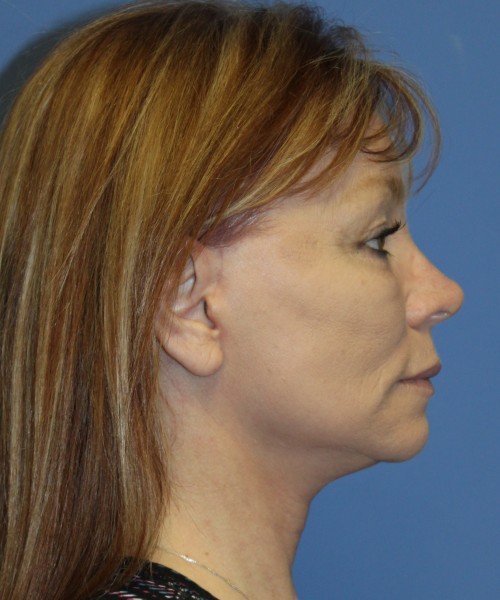 Facelift, Browlift, Blepharoplasty, and SMAS lip augmentation #5192 – Click HERE for more views after photo. Individual results may vary.
