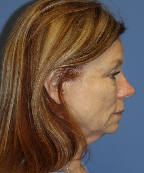 Facelift, Browlift, Blepharoplasty, and SMAS lip augmentation #5192 – Click HERE for more views before photo. Individual results may vary.