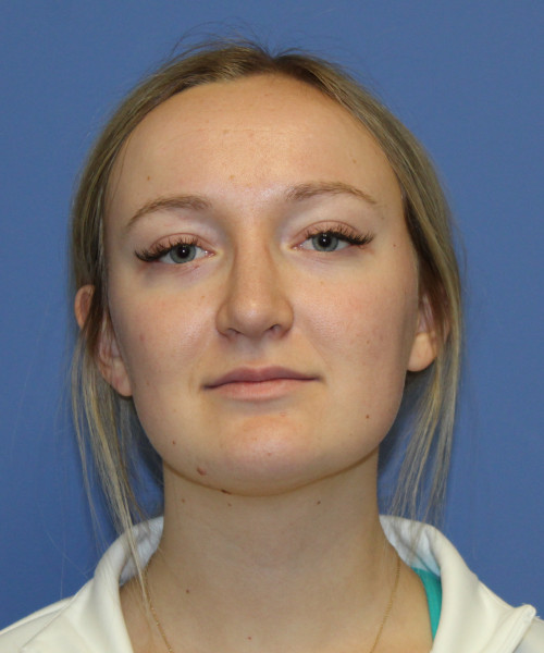 Rhinoplasty 5291 – Click HERE for more views after photo. Individual results may vary.