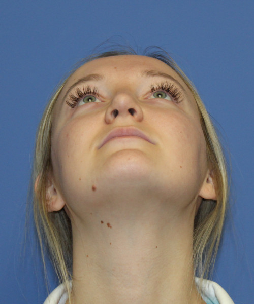 Rhinoplasty 5291 – Click HERE for more views after photo. Individual results may vary.